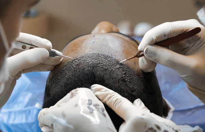 Hair Transplant