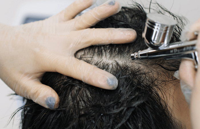 Hair Loss Treatment in Dubai