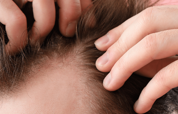 Hair Transplant Cost in Dubai