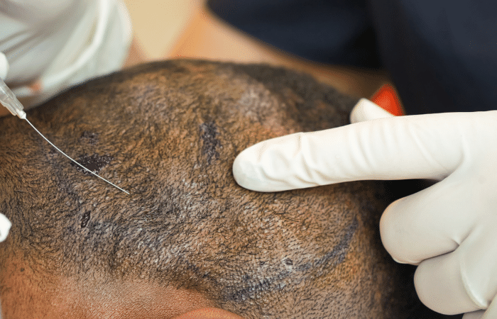 Hair Transplant in Dubai