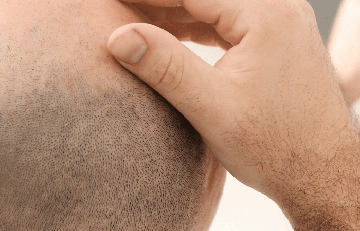Hair Transplant in Dubai