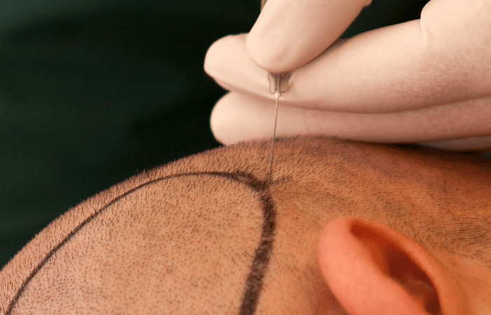 Best hair transplant clinic in Dubai