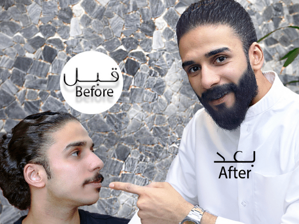 Beard transplant clinic in dubai