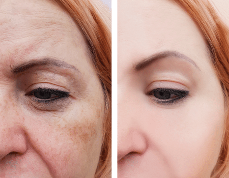 wrinkle reduction treatment